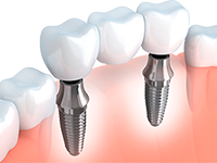 implant-supported-bridge-left