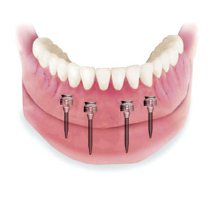 Minimally invasive Mini Dental Implants